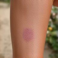 Image of a knee with a fading scrape, representing injury and trauma scar care