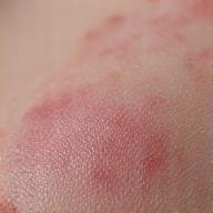 Conceptual image of a raised, red scar, representing keloid and hypertrophic scar management